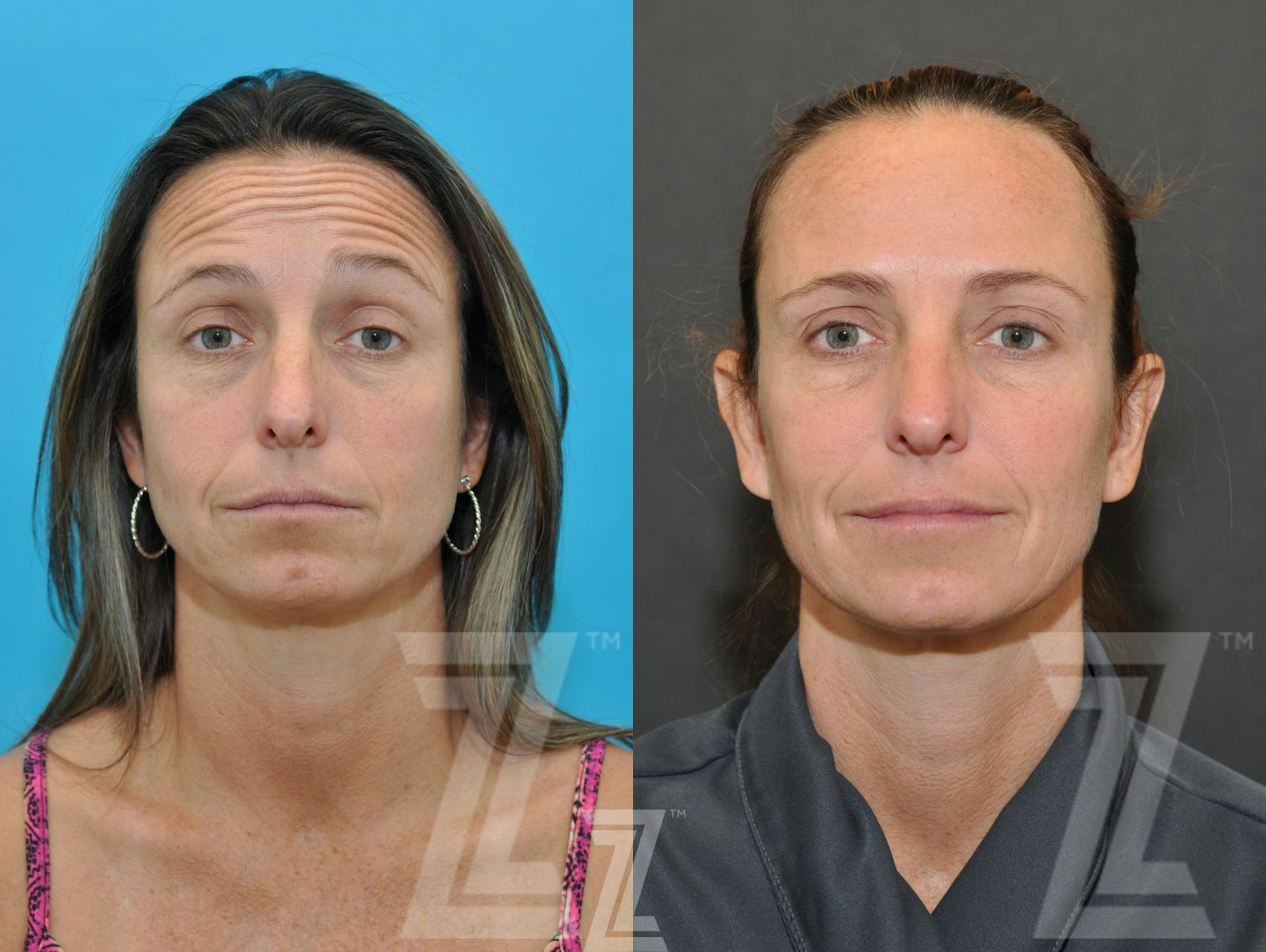 Austin Wrinkle Relaxers Before & After Gallery - Patient 132906321 - Image 2 - The Piazza Center