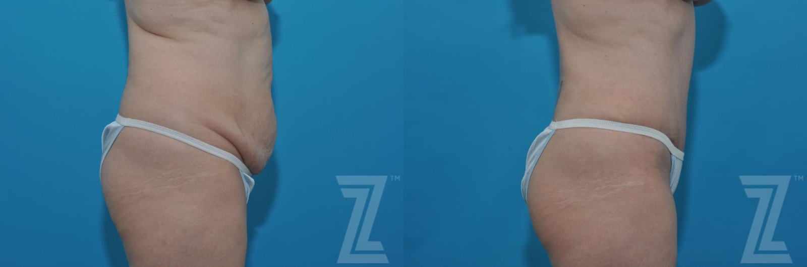 Austin Tummy Tuck Before & After Gallery - Patient 132886813 - Image 4 - The Piazza Center