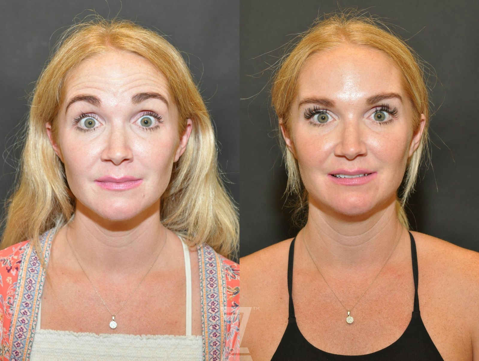 Austin Wrinkle Relaxers Before & After Gallery - Patient 132906317 - Image 2 - The Piazza Center