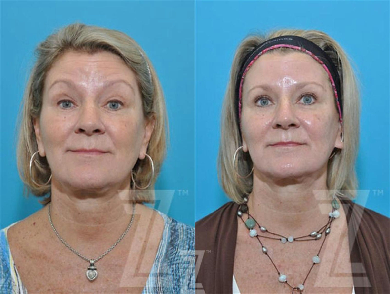Austin Wrinkle Relaxers Before & After Gallery - Patient 132906316 - Image 3 - The Piazza Center