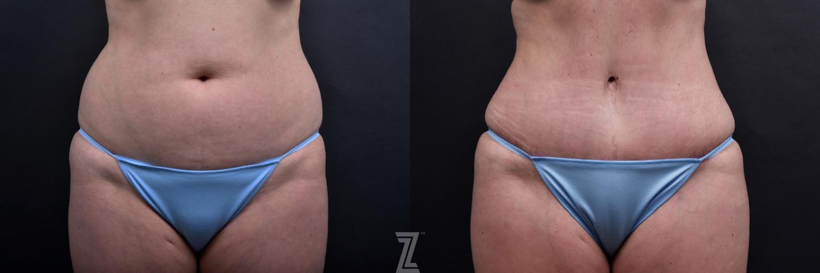 Austin Tummy Tuck Before & After Gallery - Patient 132886885 - Image 1 - The Piazza Center