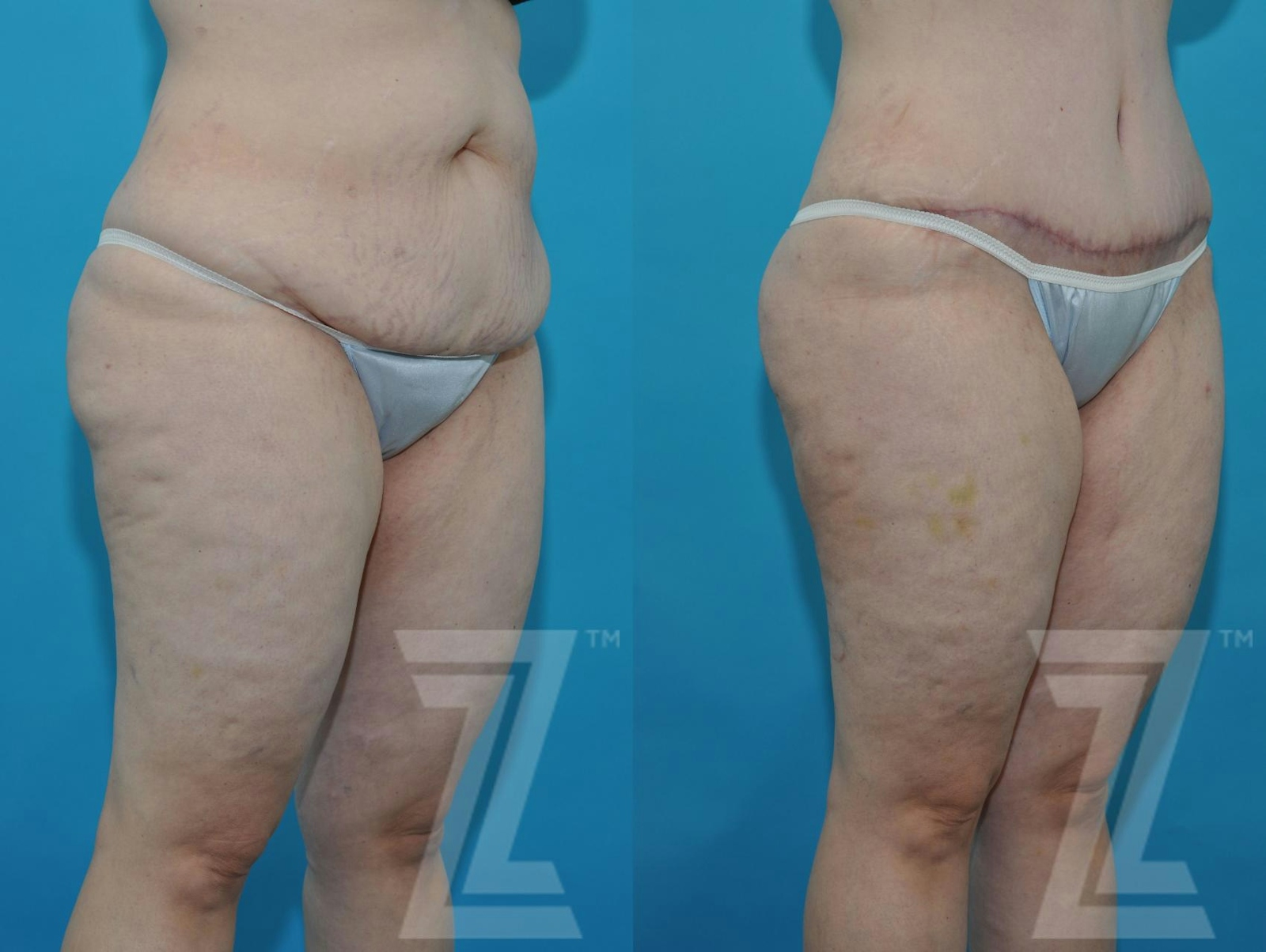 Austin Tummy Tuck Before & After Gallery - Patient 132886824 - Image 9 - The Piazza Center