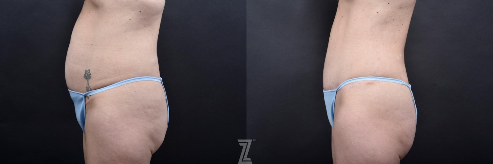 Austin Tummy Tuck Before & After Gallery - Patient 132886820 - Image 2 - The Piazza Center