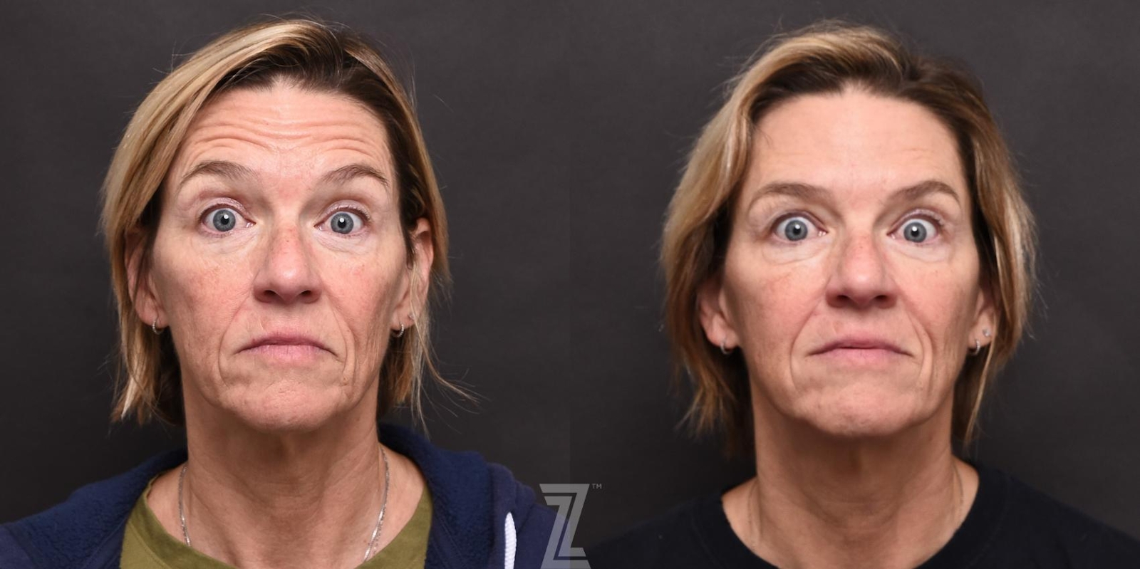 Austin Wrinkle Relaxers Before & After Gallery - Patient 132905408 - Image 1 - The Piazza Center