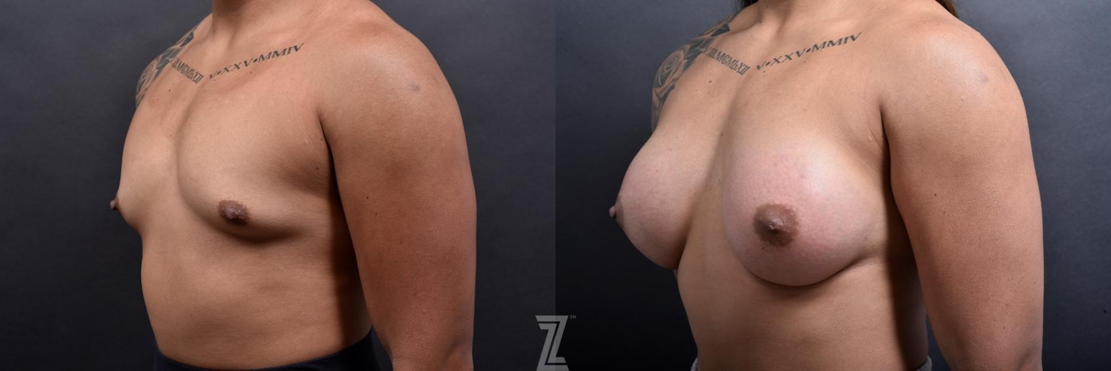Austin oblique view of before and after image 3 month post op 25 year old woman with Silicone Implants with Cohesive Silicone Gel - The Piazza Center