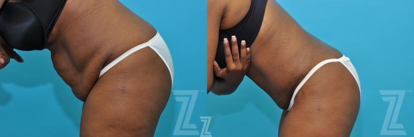 Austin Tummy Tuck Before & After Gallery - Patient 117774 - Image 3 - The Piazza Center