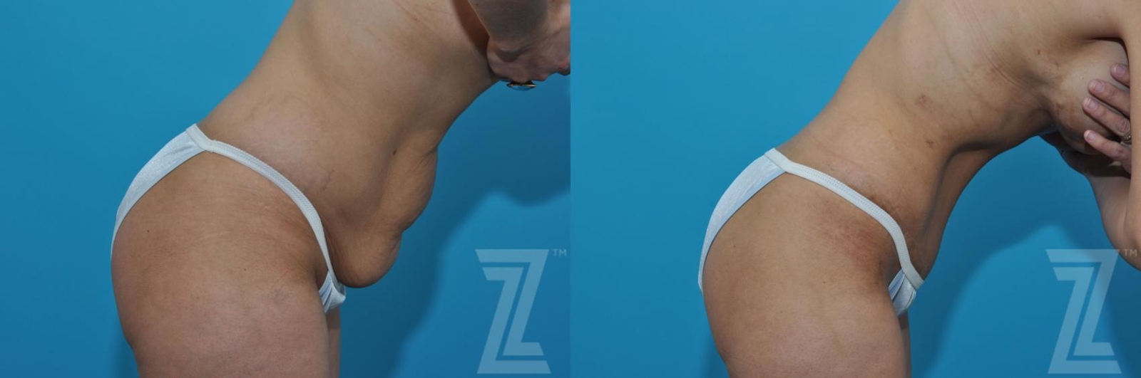 Austin Tummy Tuck Before & After Gallery - Patient 132886901 - Image 5 - The Piazza Center