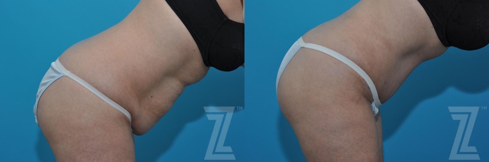 Austin Tummy Tuck Before & After Gallery - Patient 132886903 - Image 5 - The Piazza Center
