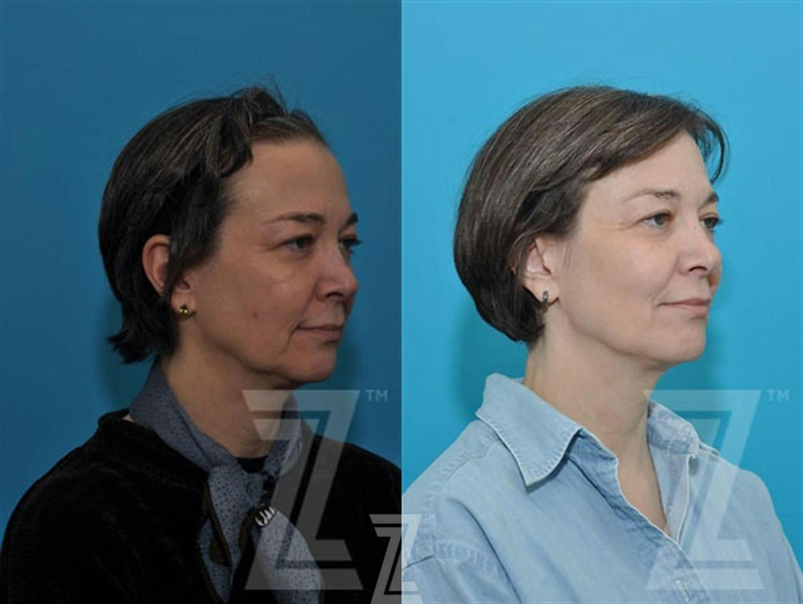 Austin Sculptra® Before & After Gallery - Patient 132963131 - Image 3 - The Piazza Center