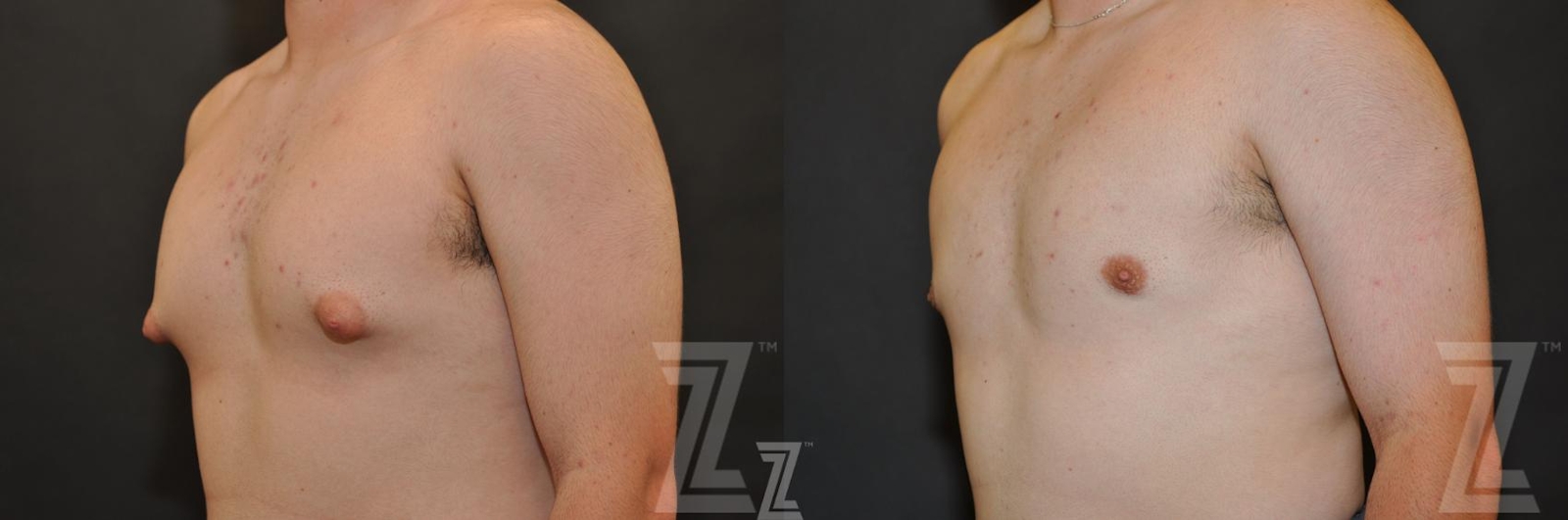 Austin Gynecomastia/Male Breast Reduction Before & After Gallery - Patient 871481 - Image 2 - The Piazza Center