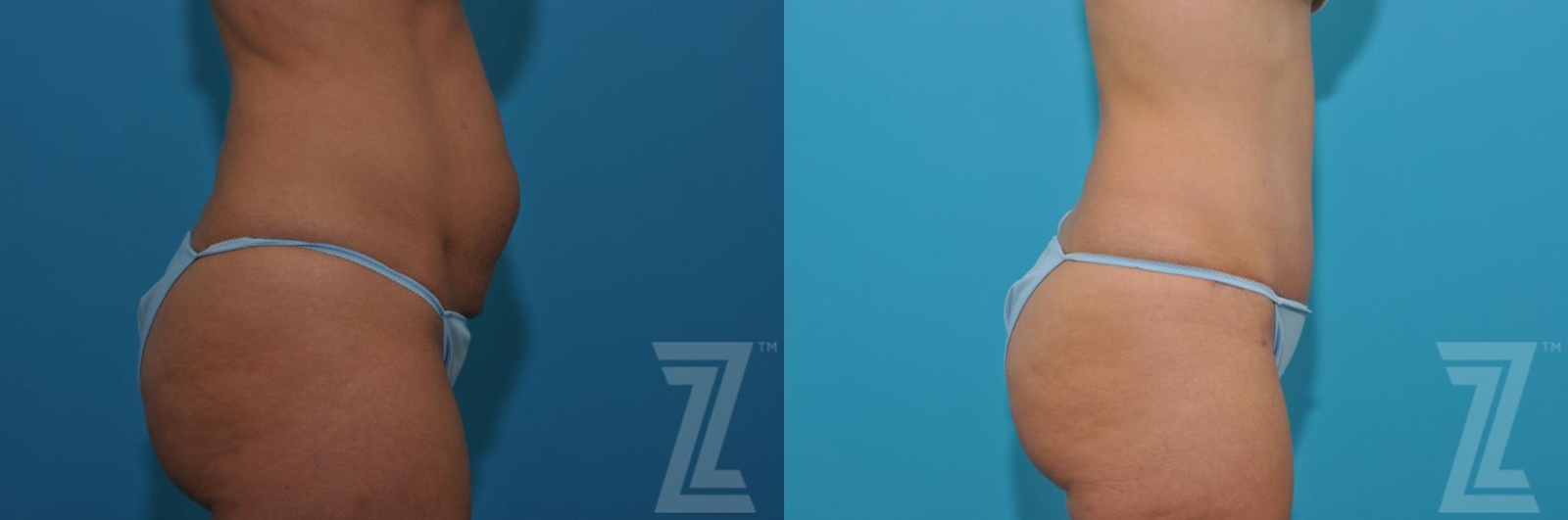 Austin Tummy Tuck Before & After Gallery - Patient 132886876 - Image 4 - The Piazza Center