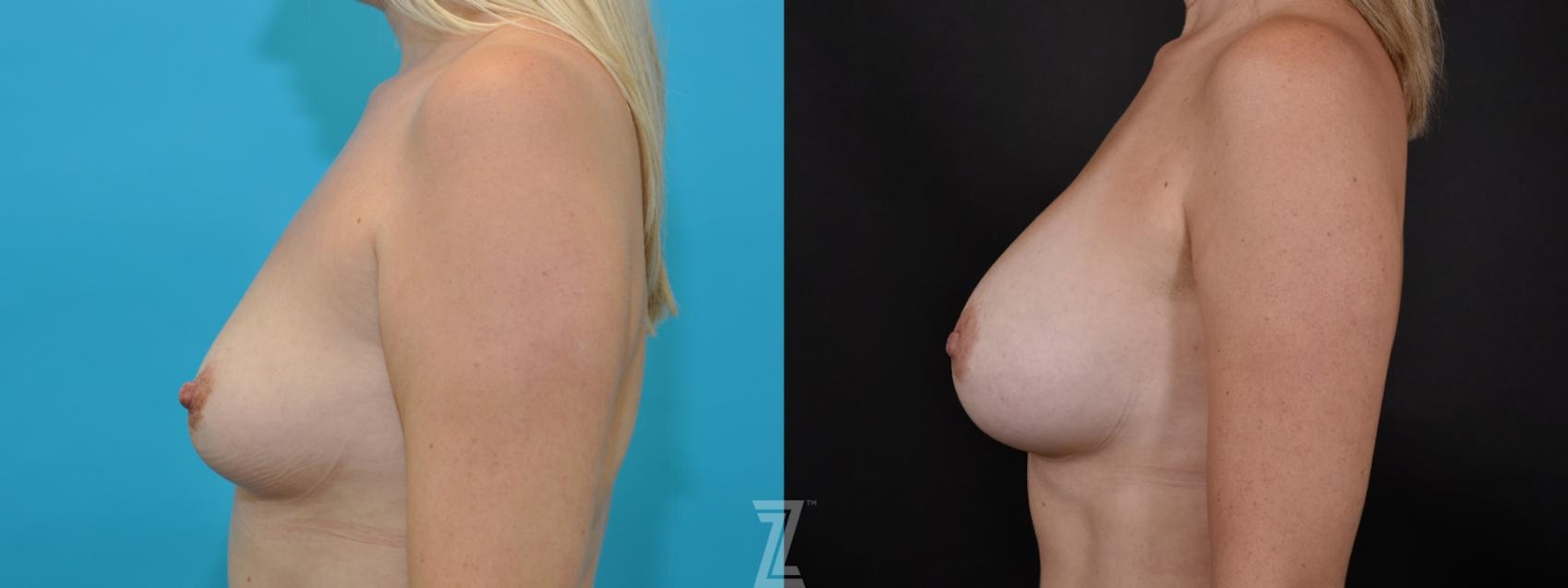 Austin 5 year post op side view before & after images of 35 year old woman with Silicone Implants with Highly Cohesive Gel (Gummy Bear Implants) - The Piazza Center