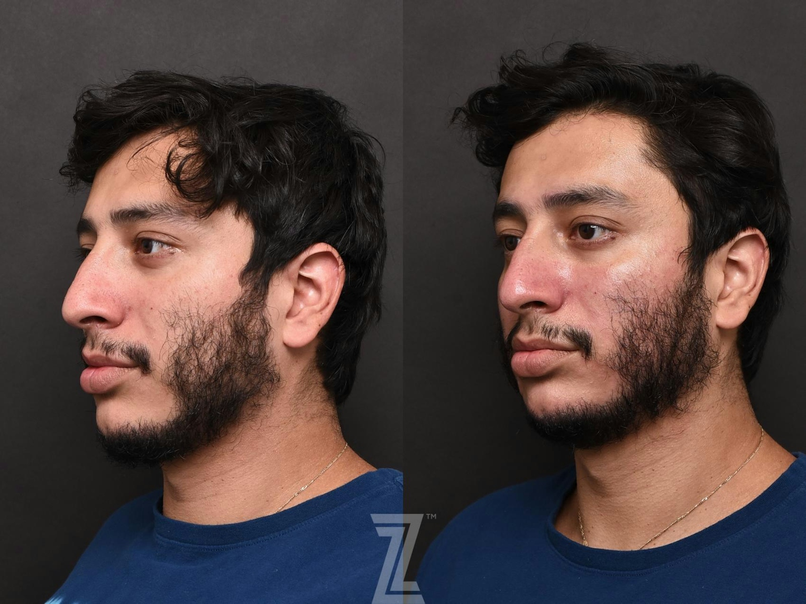 Austin HydraFacial™ Before & After Gallery - Patient 132963244 - Image 3 - The Piazza Center