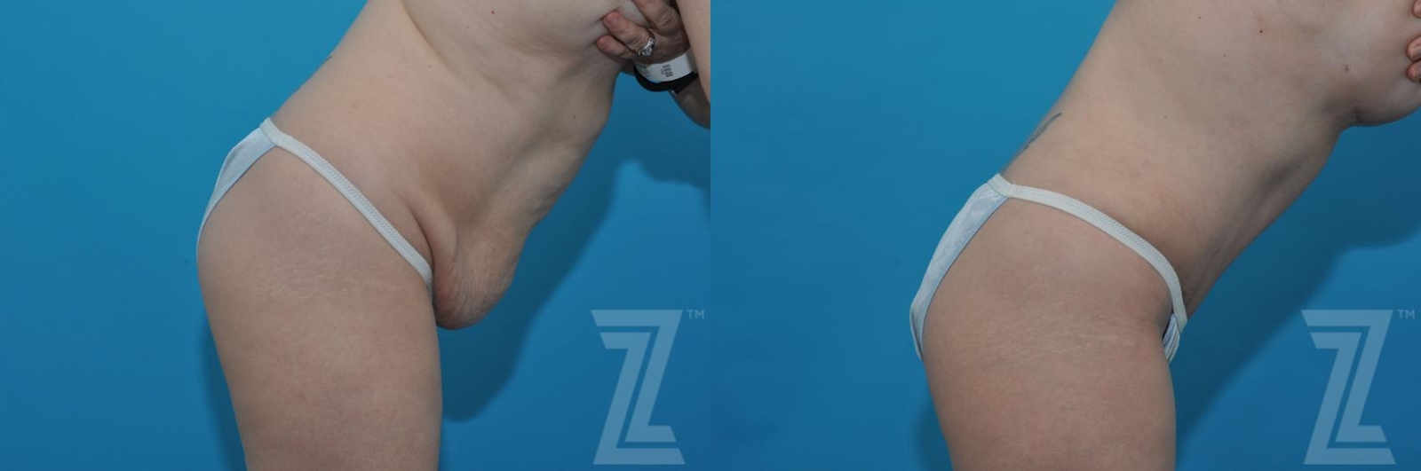 Austin Tummy Tuck Before & After Gallery - Patient 132886813 - Image 5 - The Piazza Center
