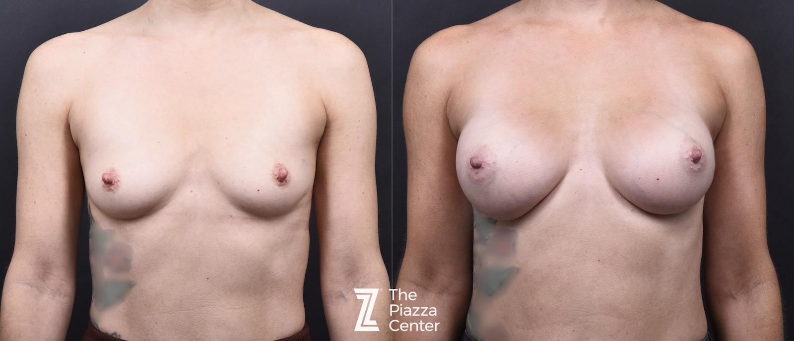 Austin Breast Augmentation Before & After Gallery - Patient 141191 - Image 1 - The Piazza Center