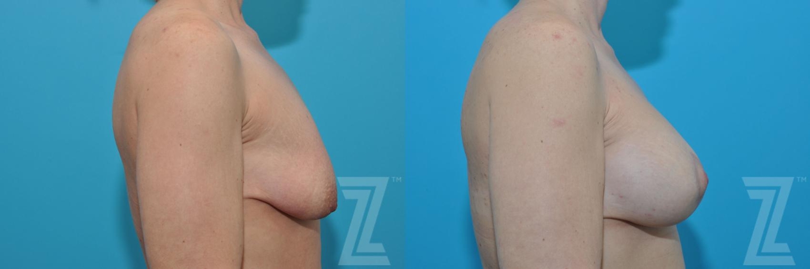 Austin Breast Augmentation With a Breast Lift Before & After Gallery - Patient 132791127 - Image 5 - The Piazza Center