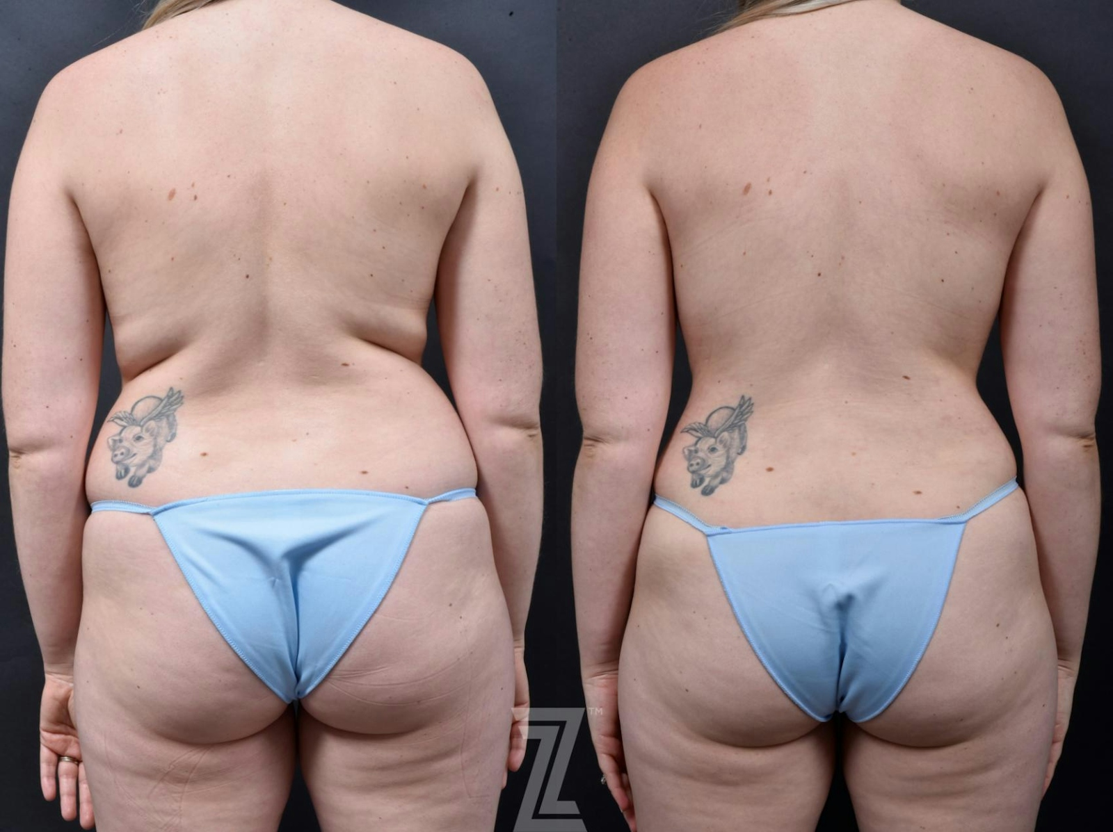Austin 29-Year-Old Mommy Makeover Before & After by Dr. Rocco Piazza in Austin, Texas - Posterior View - The Piazza Center