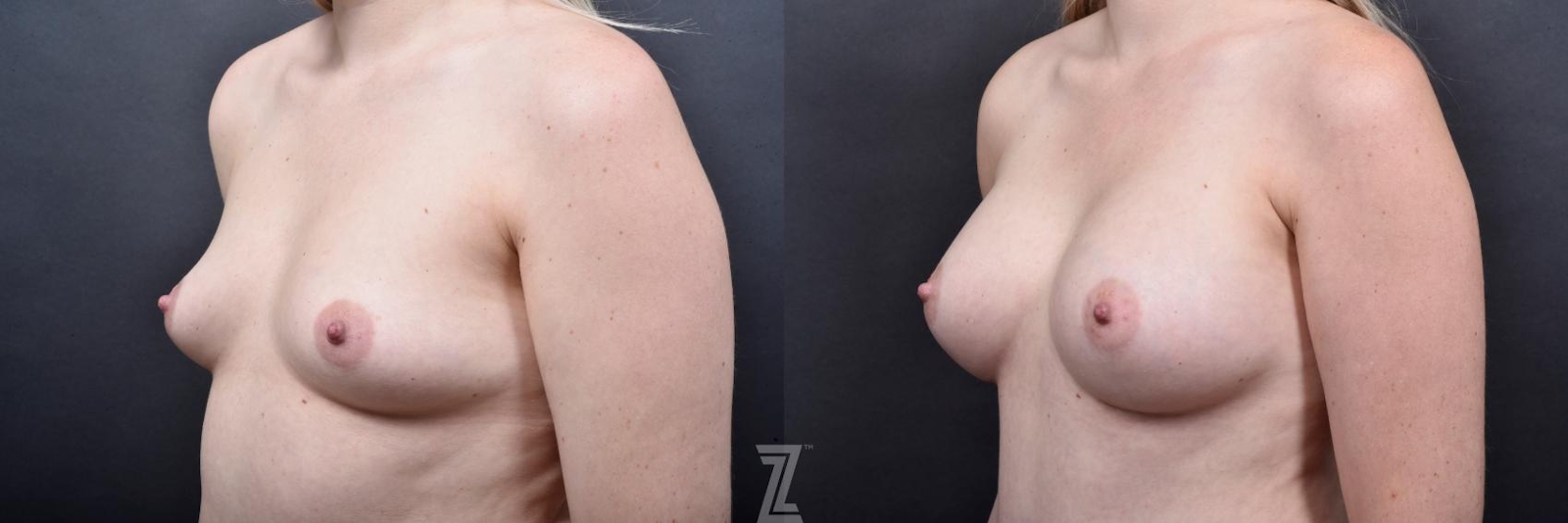 Austin Oblique View of Breast of 29-Year-Old Mommy Makeover Before & After by Dr. Rocco Piazza in Austin, Texas - The Piazza Center