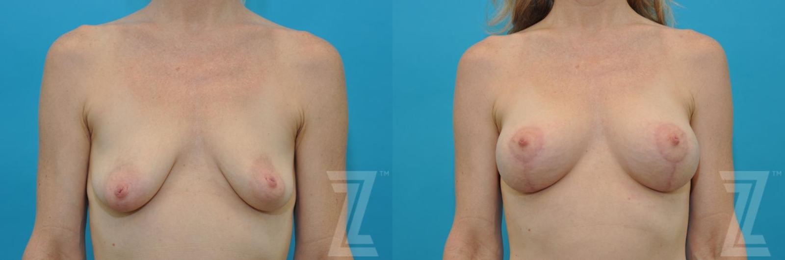 Austin Breast Lift Before & After Gallery - Patient 132791069 - Image 1 - The Piazza Center