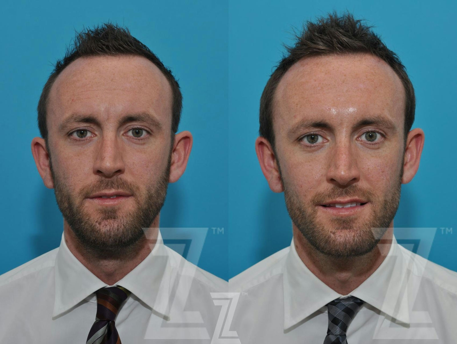 Austin Wrinkle Relaxers Before & After Gallery - Patient 132905409 - Image 1 - The Piazza Center
