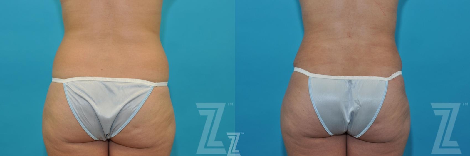 Austin Before & After images posterior view of 40-year-old mother of five mommy maker over - Dr. Rocco Piazza, Austin TX - The Piazza Center