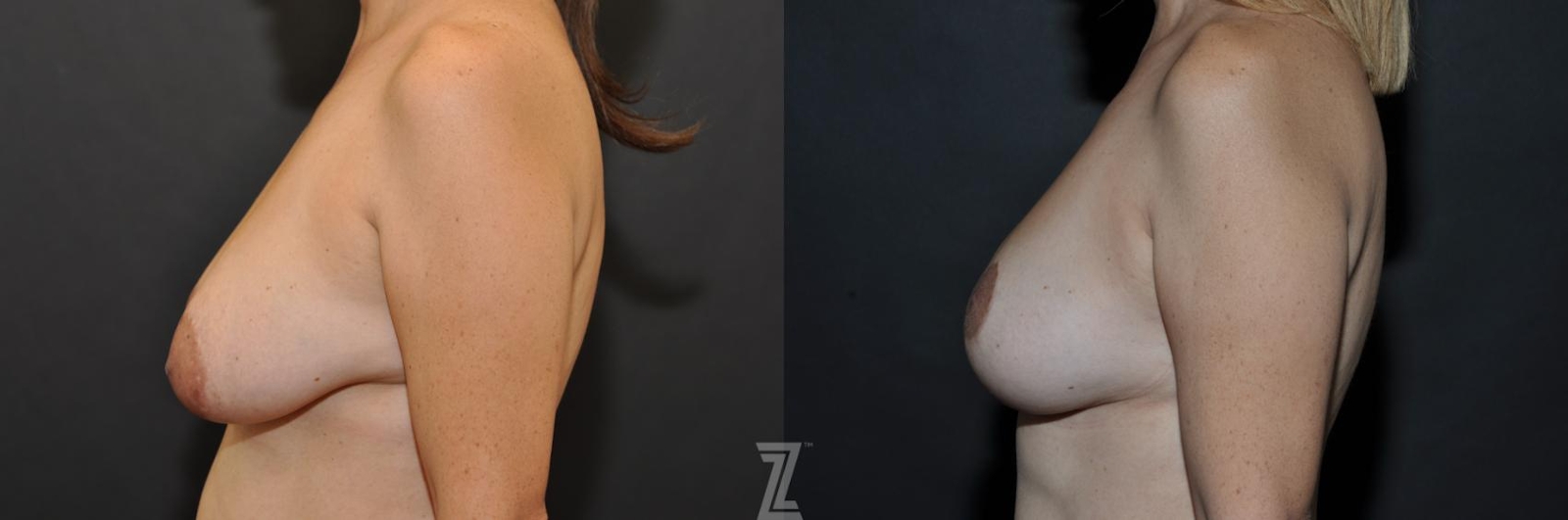Austin Breast Reduction Before & After Gallery - Patient 132886614 - Image 3 - The Piazza Center