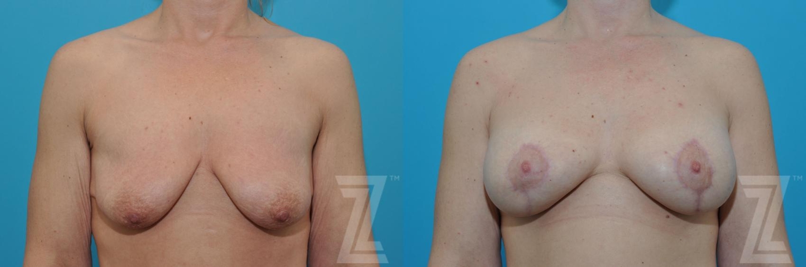 Austin Breast Augmentation With a Breast Lift Before & After Gallery - Patient 132791127 - Image 1 - The Piazza Center