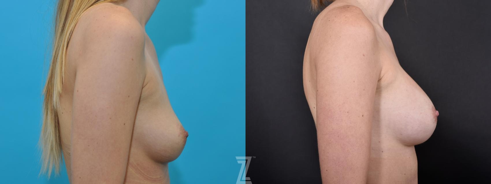 Austin Lateral before and after image of 25 year old woman with Silicone Implants with Highly Cohesive Gel (Gummy Bear Implants) - The Piazza Center