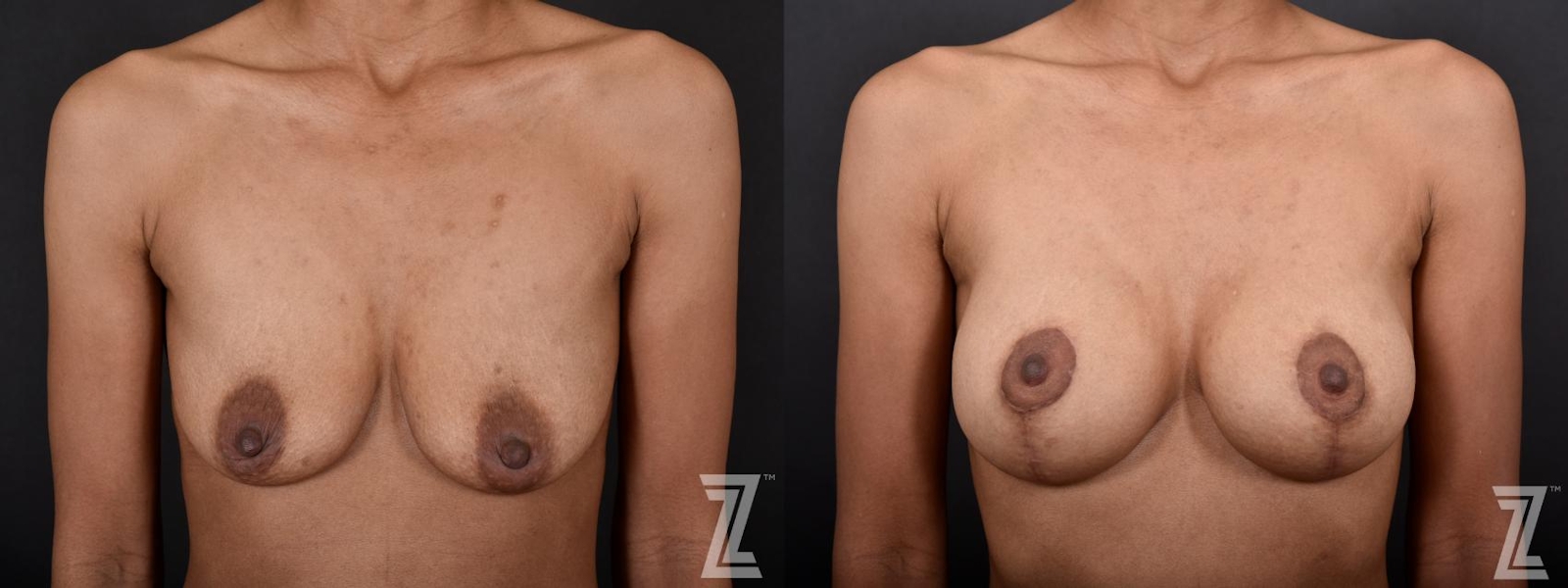 Austin Frontal View of Breast of 34-Year-Old Mom of Three Children Mommy Makeover Before & After by Dr. Rocco Piazza in Austin, Texas - The Piazza Center