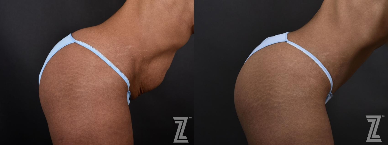 Austin Lateral View of Abdomen in Flexion of 34-Year-Old Mom, with Three Children - Mommy Makeover Before & After by Dr. Rocco Piazza in Austin, Texas - The Piazza Center