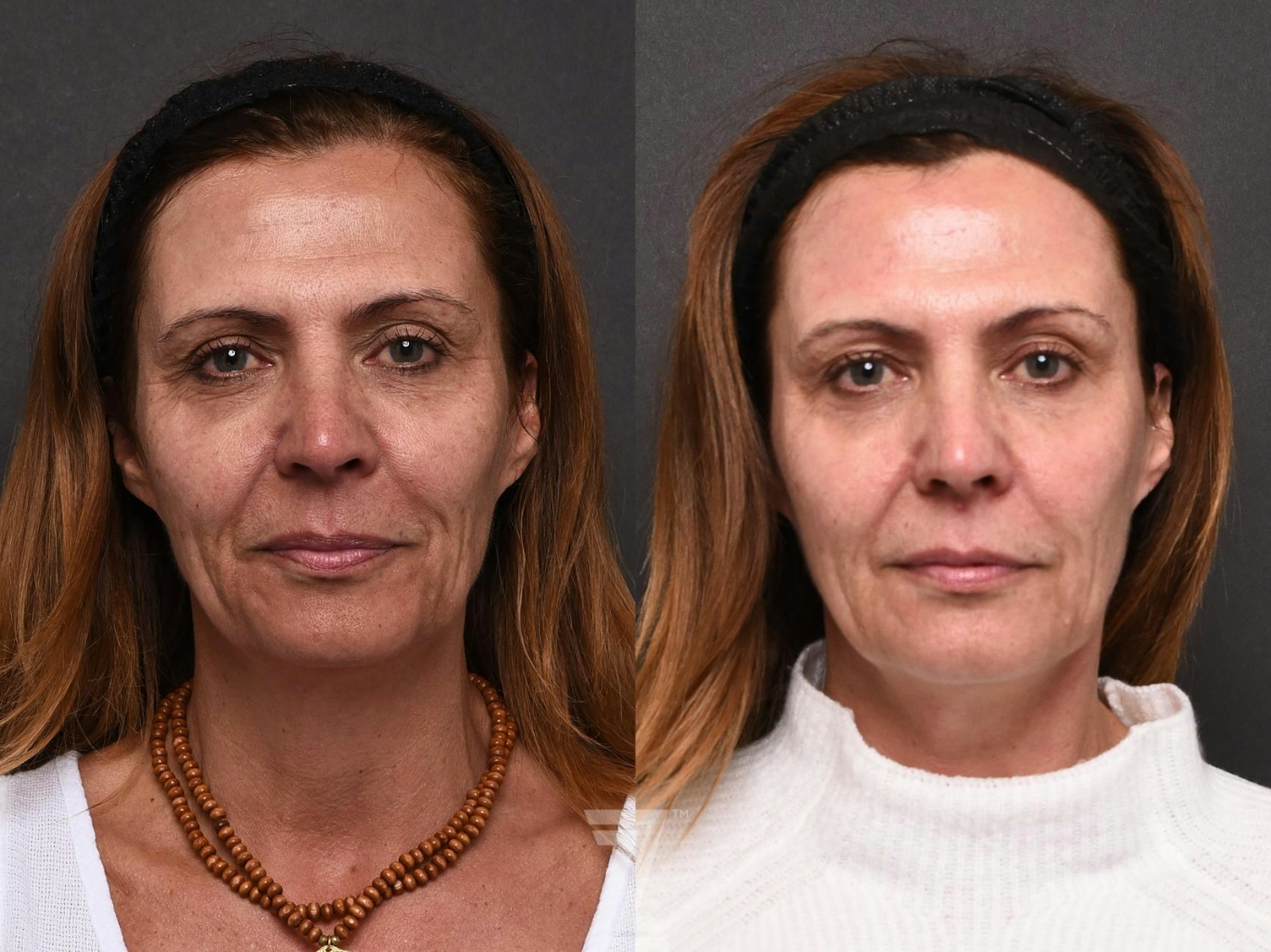 Austin HALO Before & After Gallery - Patient 132963260 - Image 1 - The Piazza Center