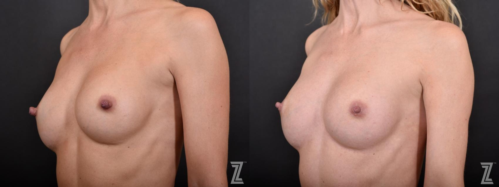 Austin Nipple Reduction Before & After Gallery - Patient 132886788 - Image 2 - The Piazza Center