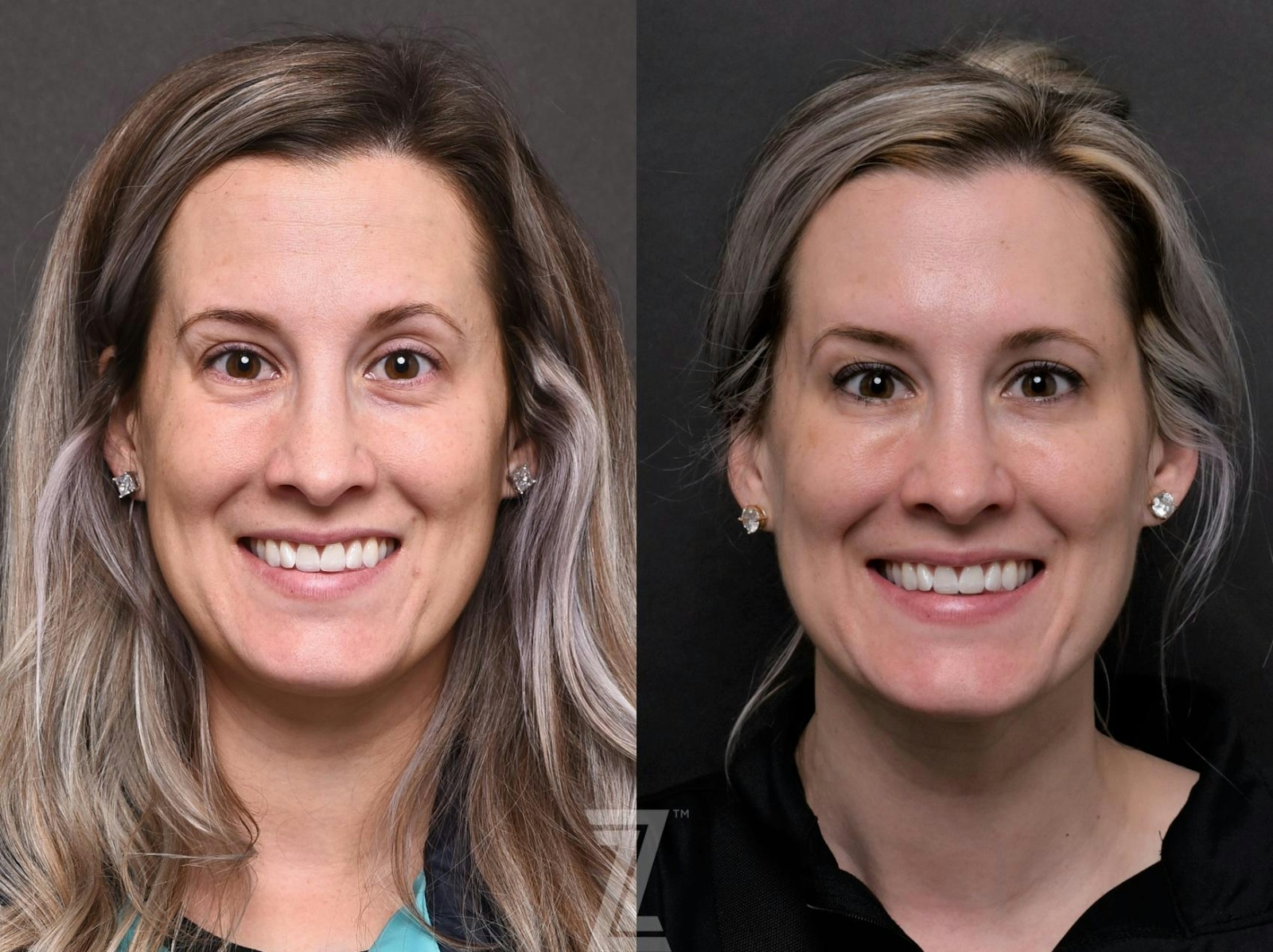 Austin Injectable Fillers Before & After Gallery - Patient 132963122 - Image 1 - The Piazza Center