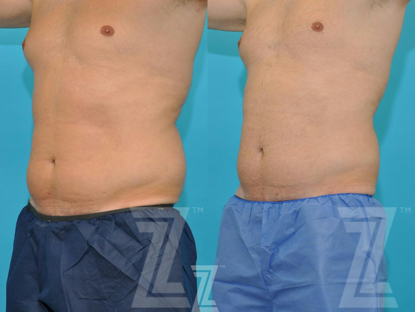 Austin Non-Surgical Male Body Contouring Before & After Gallery - Patient 250517 - Image 1 - The Piazza Center