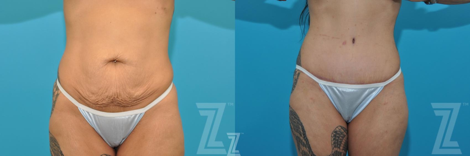 Austin Tummy Tuck Before & After Gallery - Patient 377913 - Image 1 - The Piazza Center