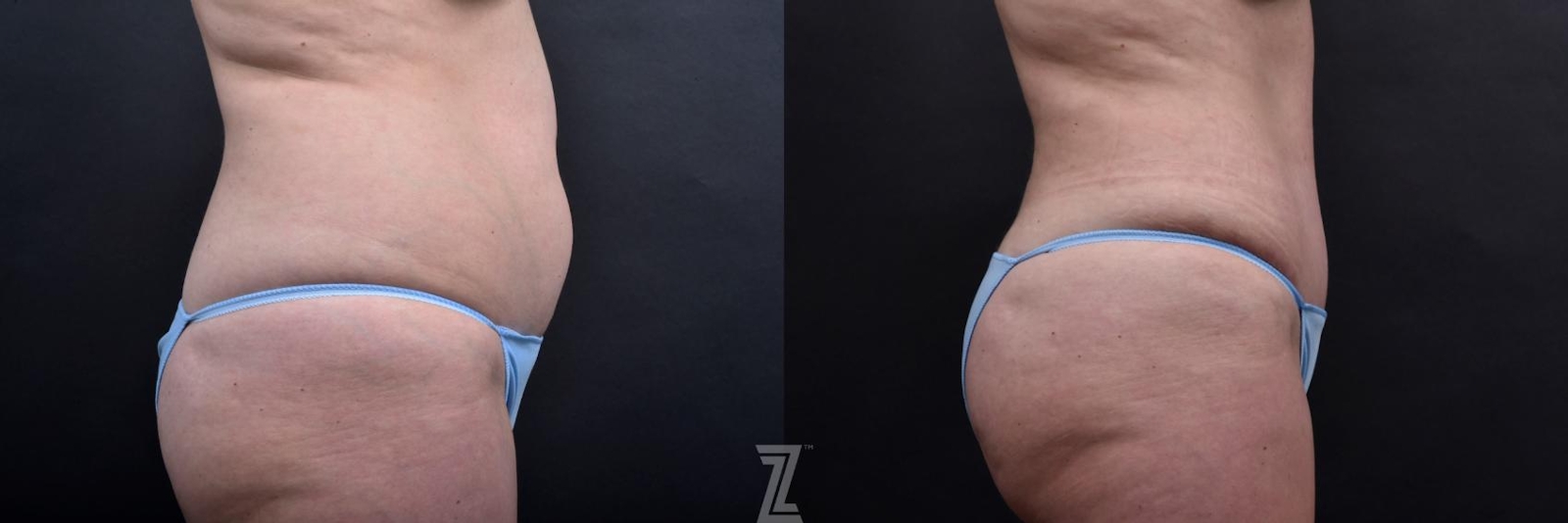 Austin Tummy Tuck Before & After Gallery - Patient 132886885 - Image 5 - The Piazza Center