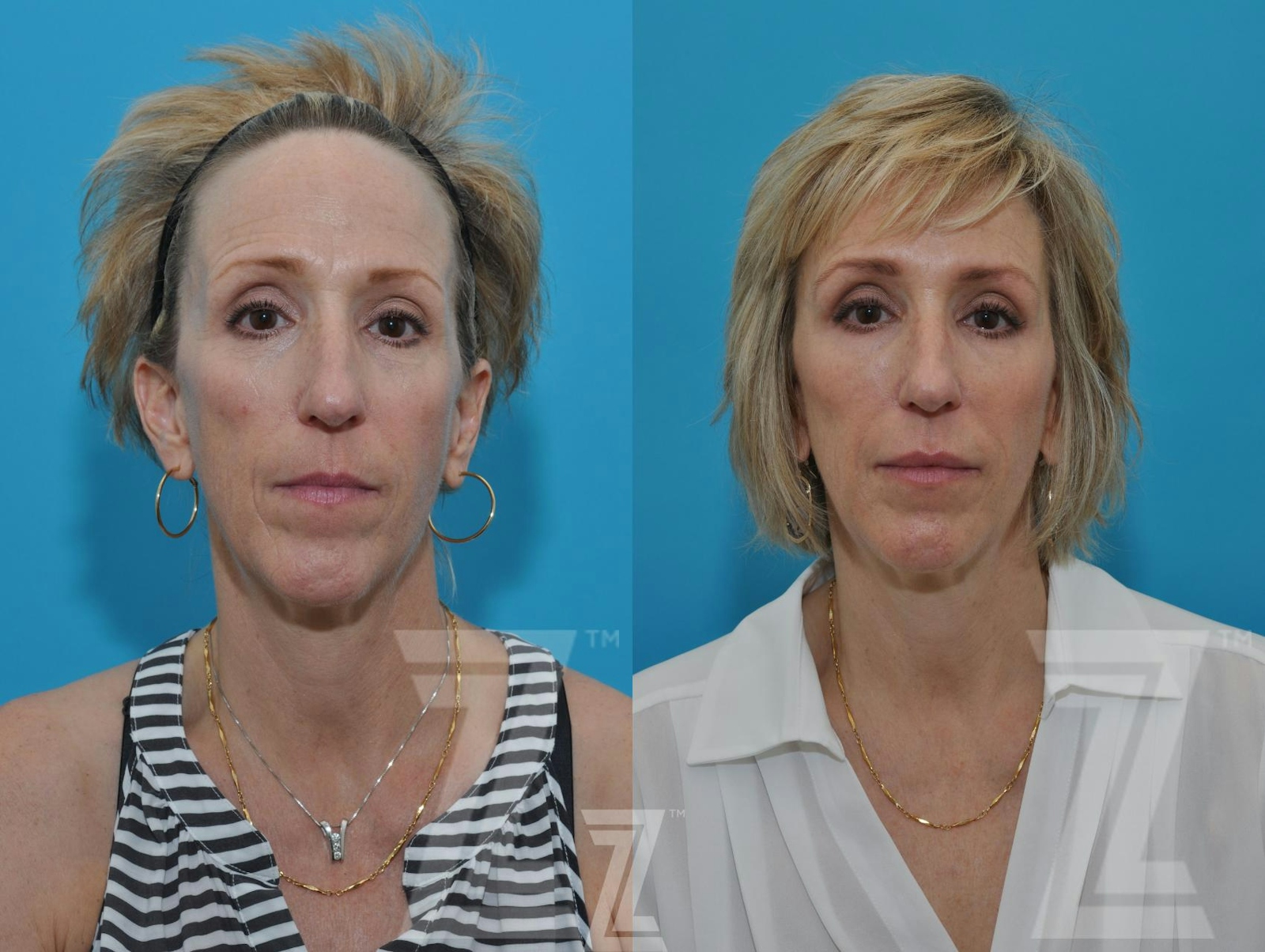 Austin Injectable Fillers Before & After Gallery - Patient 132963096 - Image 1 - The Piazza Center