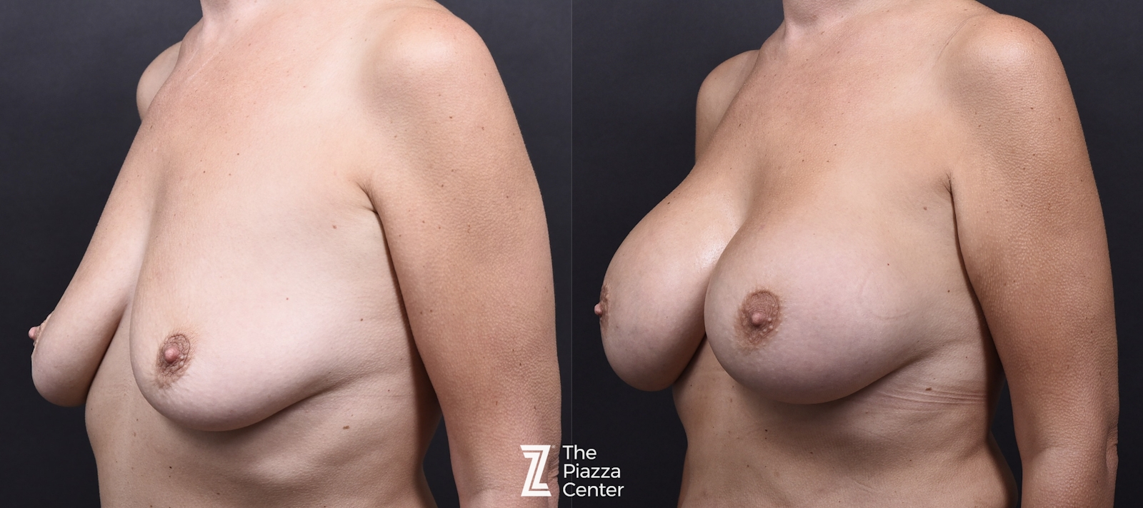 Austin Breast Augmentation Before & After Gallery - Patient 345874 - Image 4 - The Piazza Center