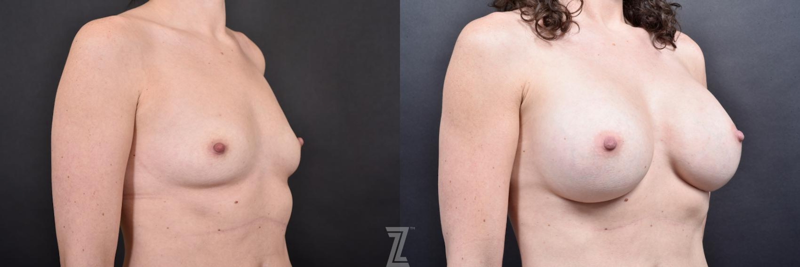 Austin Oblique view before & after images of 34 year old woman with Silicone Implants with Cohesive Silicone Gel - Dr. Rocco Piazza - The Piazza Center