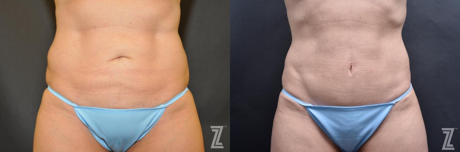 Austin Skin Pinch Before & After Gallery - Patient 132886938 - Image 1 - The Piazza Center