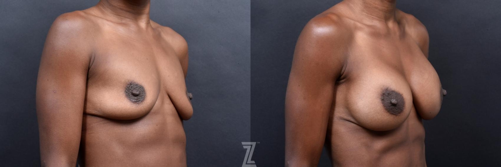Austin oblique before and after view of 33 year old athletic mom of two children breast augmentation - The Piazza Center