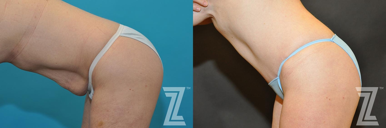 Austin Tummy Tuck Before & After Gallery - Patient 132886891 - Image 3 - The Piazza Center