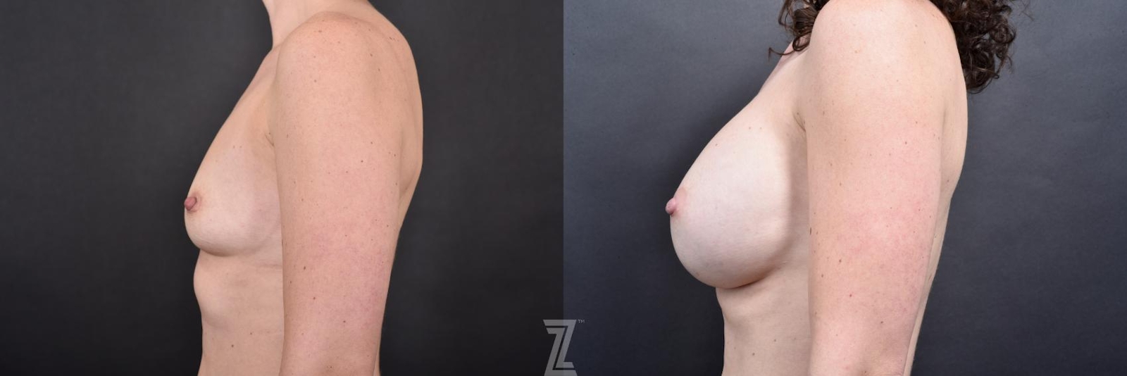 Austin Lateral view before & after images of 34 year old woman with Silicone Implants with Cohesive Silicone Gel - Dr. Rocco Piazza - The Piazza Center