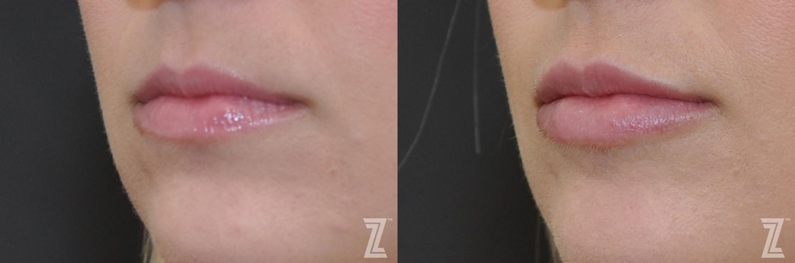 Austin Injectable Fillers Before & After Gallery - Patient 132963115 - Image 2 - The Piazza Center