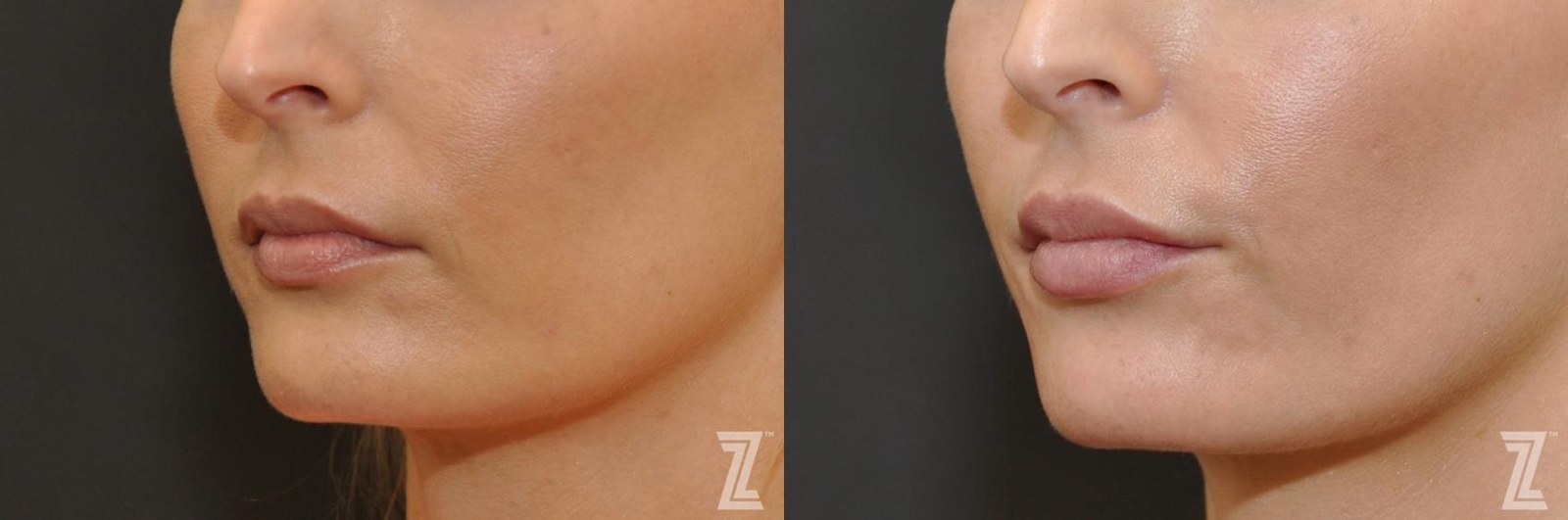 Austin Injectable Fillers Before & After Gallery - Patient 132963103 - Image 1 - The Piazza Center