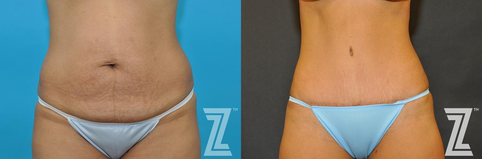 Austin Tummy Tuck Before & After Gallery - Patient 132886888 - Image 1 - The Piazza Center