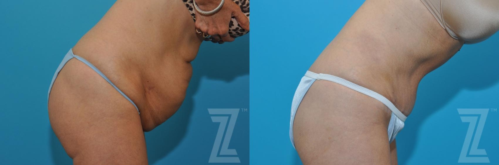 Austin Tummy Tuck Before & After Gallery - Patient 132886871 - Image 5 - The Piazza Center