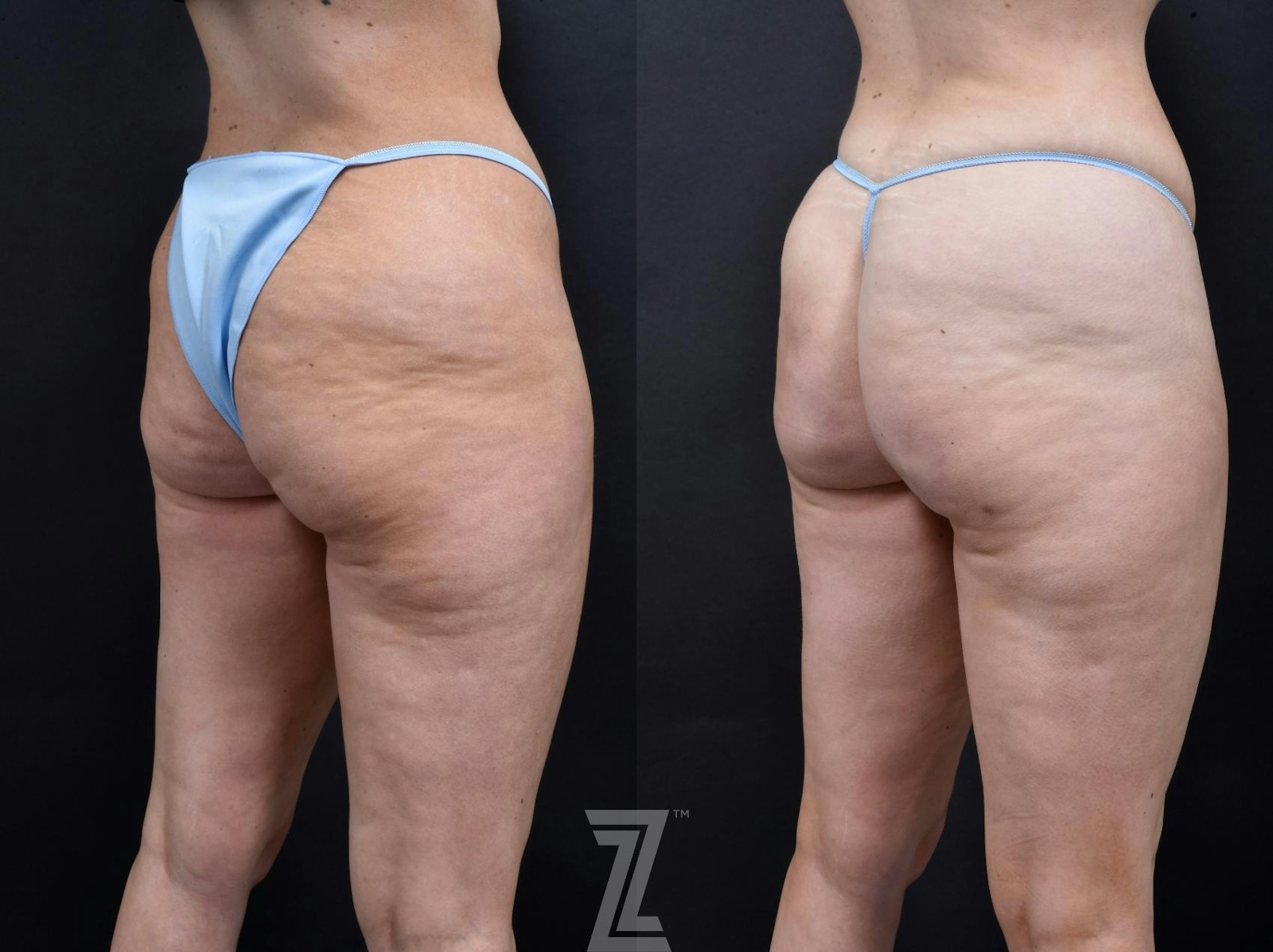 Austin Avéli Before & After Gallery - Patient 132905400 - Image 3 - The Piazza Center