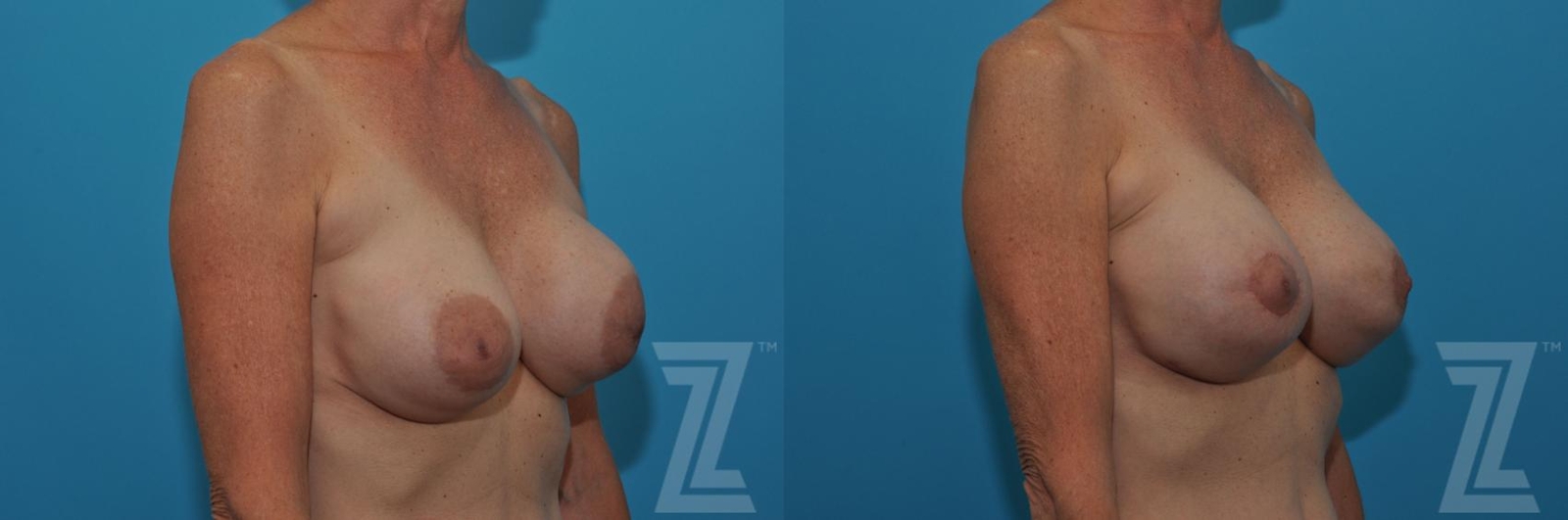 Austin Breast Augmentation Revision Before & After Gallery - Patient 132886537 - Image 3 - The Piazza Center
