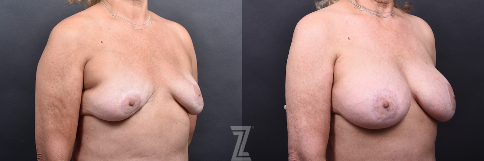 Austin Breast Lift Before & After Gallery - Patient 199955 - Image 2 - The Piazza Center